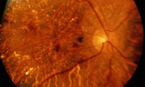 Ophthalmology